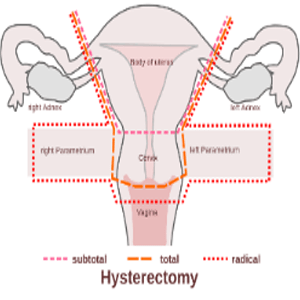 Laparoscopic Wertheim's Hysterectomy