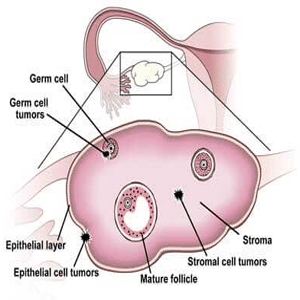 Laparoscopic Mgt of Ovarian Pathology